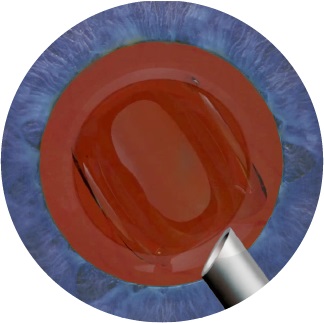 vector implante lente intraocular