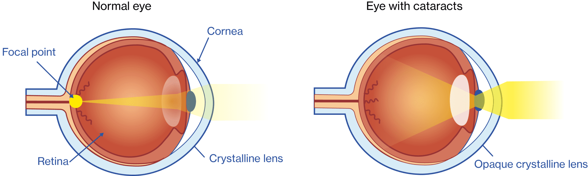 Normal eye without cataracts