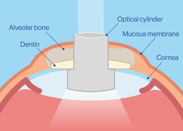 Osteo-Odonto keratoprosthesis