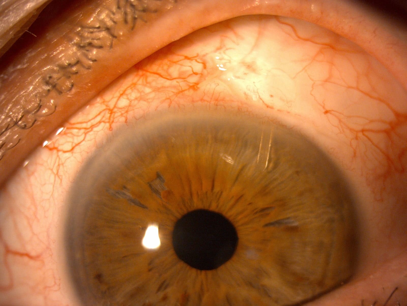 Operación glaucoma con implante