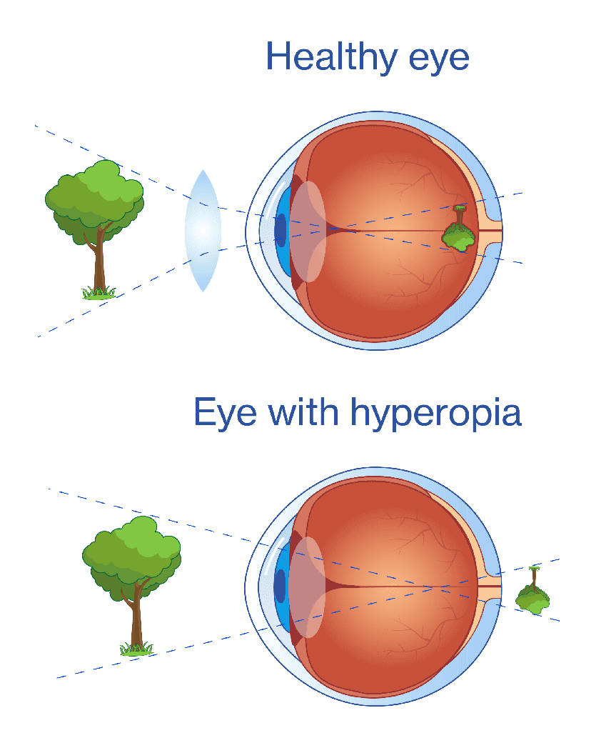 Eye with hiperopya