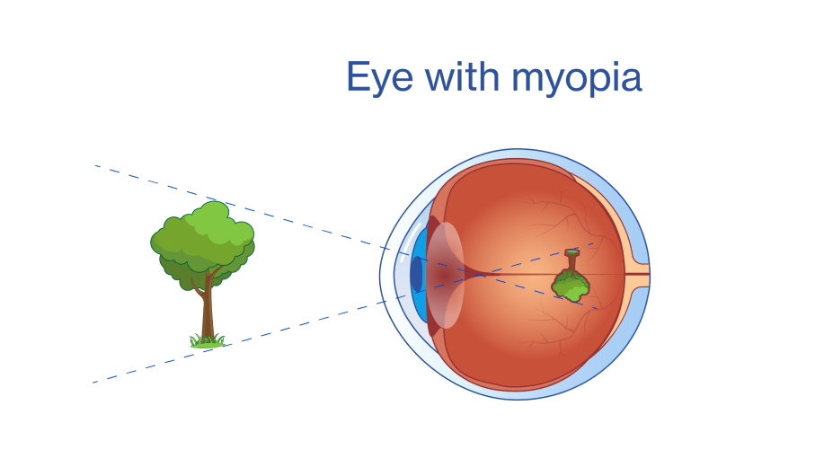 Eye with myopia