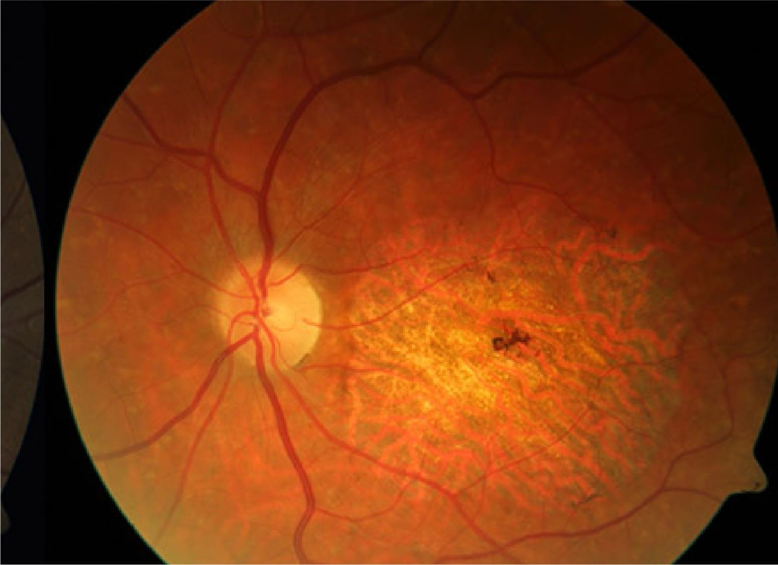 Distrofia en la retina fondo de ojo