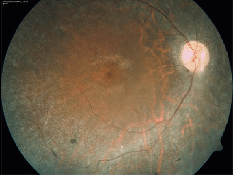 Fondo de ojo con retinosis pigmentaria