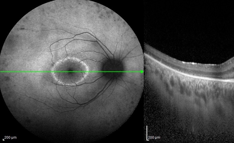 Fondo de ojo - Tomografía de coherencia óptica