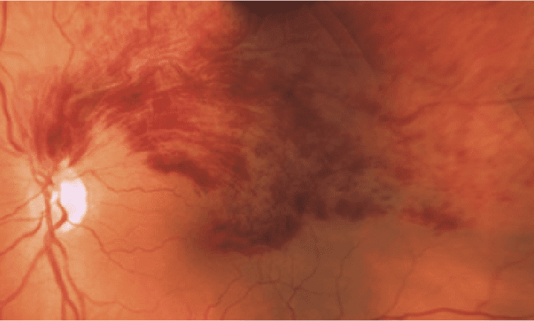 Oclusión de la vena central de la retina - Fondo de ojo